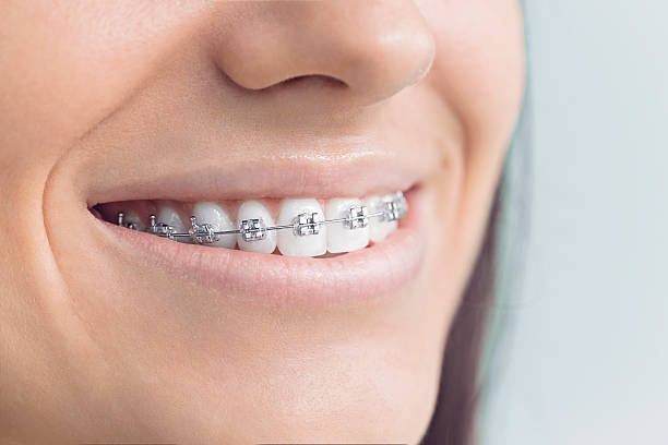 Dental Bonding in North Hornell, NY